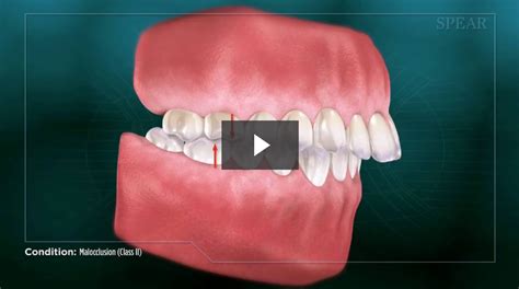 Malocclusion (Class II) - Cosmetic Dentistry