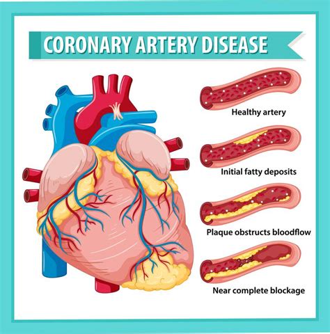 Coronary Artery Disease treatment without Surgery