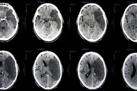 Limiting brain damage in stroke patients by controlling inflammation ...