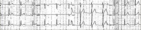 The Diagnosis: Benign Early Repolarization : Emergency Medicine News