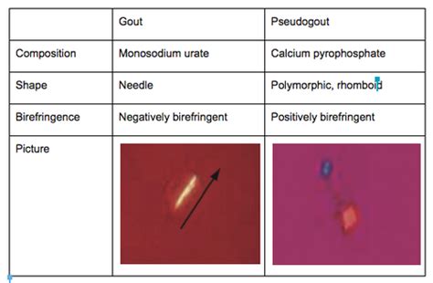 Gout and Pseudogout Flashcards | Quizlet