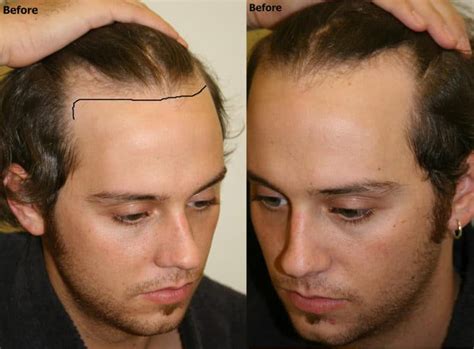 Hairline Restoration Case Study - Alvi Armani - Hair Transplant Los Angeles