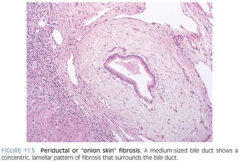 Biliary Tract Disease and Cholestatic Liver Disease | Abdominal Key