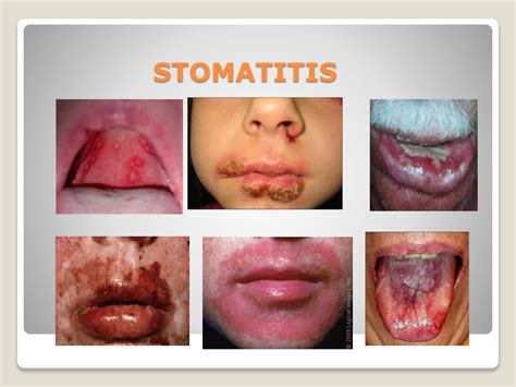 PPT - Medical English Stomatitis PowerPoint Presentation, free download - ID:6570113