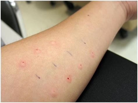 Intradermal tests; Passive Transfer Test; Prausnitz-Kustner Test