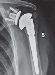 Patient Avoids Shoulder Surgery By Using Stem Cells