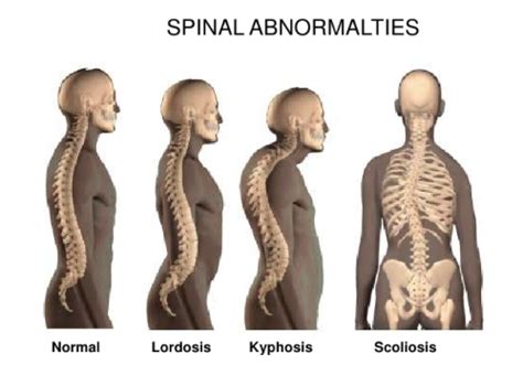 Spinal curvature abnormalities | Scoliosis, Scoliosis exercises ...