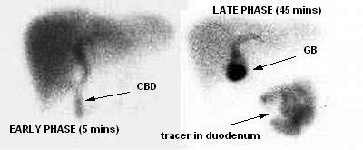 Cholecystitis (Suspected Acute)