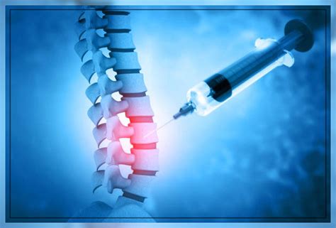 Epidural Injection: What is it, Procedure, and More - Engiomed