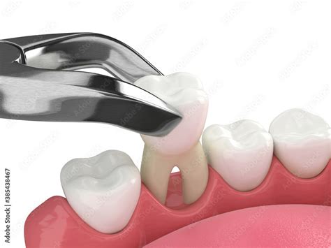 3d render of lower jaw with tooth extraction Stock Illustration | Adobe ...