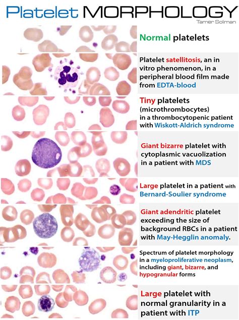 Platelet Morphology | Medical laboratory science, Hematology, Medical laboratory technician