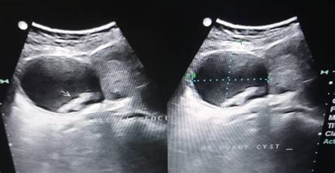 Hemorrhagic Cyst Mri