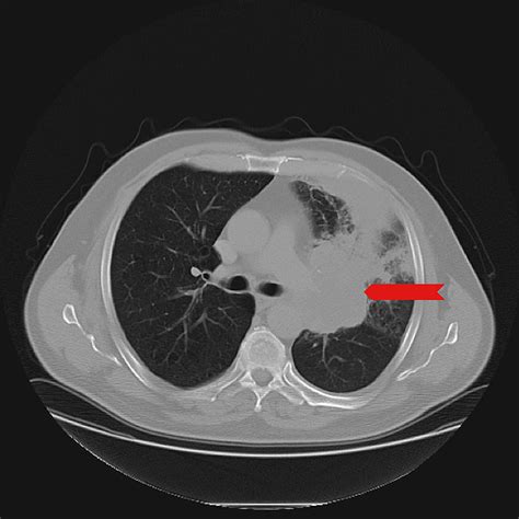 Non-small Cell Lung Cancer with Squamous Features Metastatic to a ...