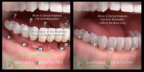 What types of dental implants are available - Dental News Network