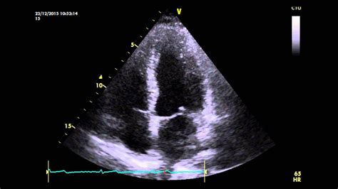 Apical Pulse Normal Range