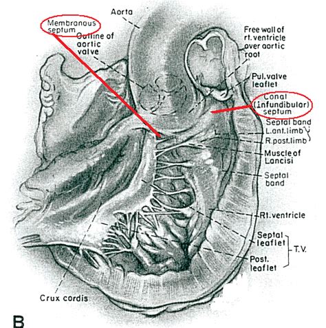 Ventricular septum anatomy - wikidoc