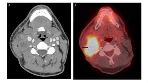 A case of isolated metastasis to right level II cervical lymph node from intrahepatic ...