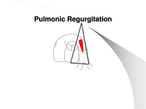 PPT - Pulmonic Regurgitation PowerPoint Presentation, free download - ID:755506