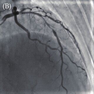 Coronary angiography results. Coronary angiography showed long and ...