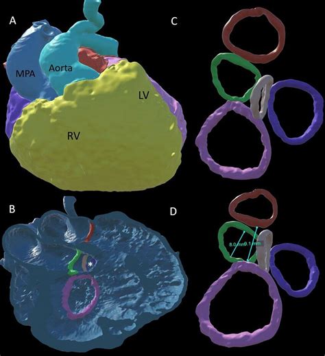 DORV with subaortic VSD and key annuli landmarks. Three-dimensional ...