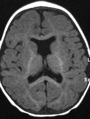 Holoprosencephaly Imaging: Practice Essentials, Radiography, Computed ...