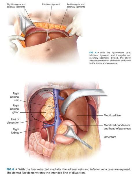 Adrenalectomy