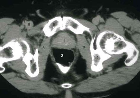 CT Scan of the Prostate