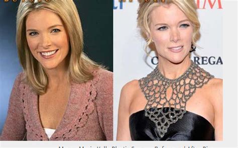 Megyn Kelly Plastic Surgery Before and After