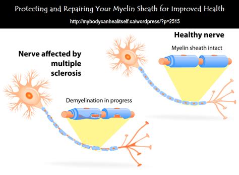 NATURAL CURES: Protecting and Repairing the Myelin Sheath for Improved Health | Health by Design