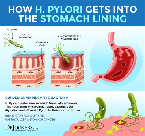 The Damaging Effects of H Pylori Infections - DrJockers.com