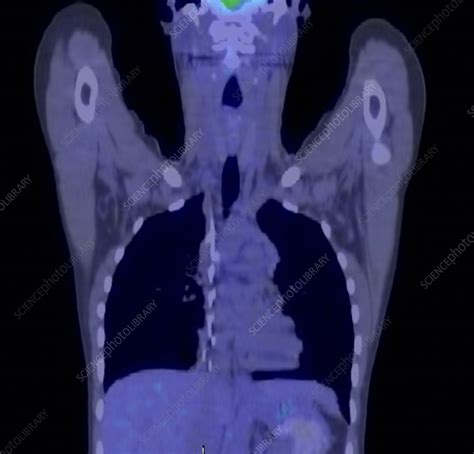 Hodgkin's lymphoma treatment, PET scan - Stock Image - C001/7582 ...