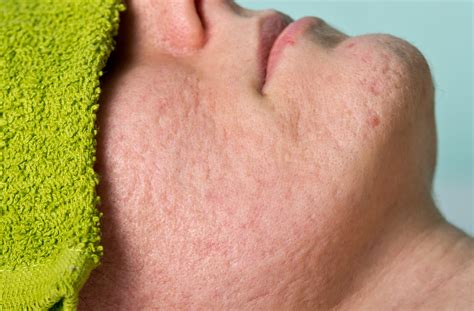 How to Get Rid of Acne Scars Fast: 9 Treatments & How They Work