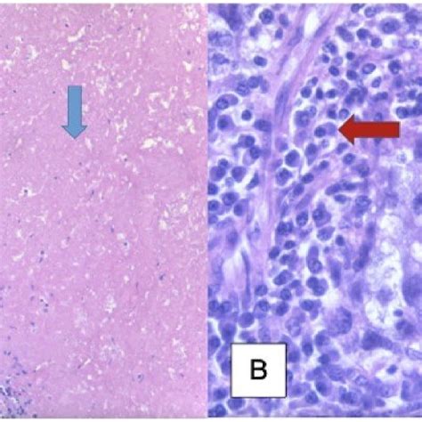 Histology slides of pelvic seminoma; slide A shows areas of tumor ...