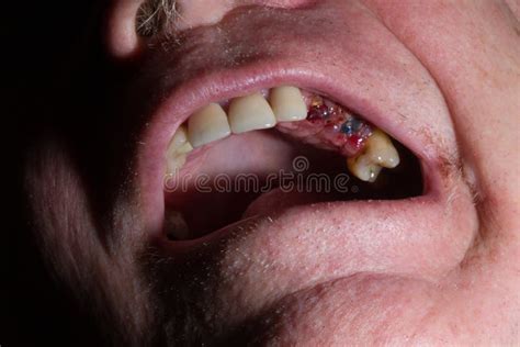 Endosteal Implant in Jaw of Sixty-five Year Old Male after Failure of Three Crowned Teeth. Photo ...