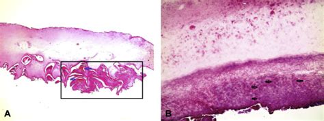 Clinical, dermoscopic, and pathologic features of onychopapilloma: A ...