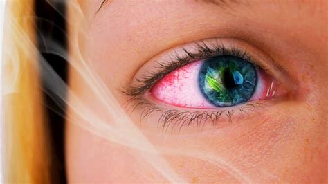 Why Does Weed Make Your Eyes Red (and How to Get Rid of Red Eyes)