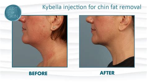 Kybella by Kythera injection fat removal from chin - YouTube