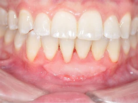 Before and After Gum Recession Treatment Photos