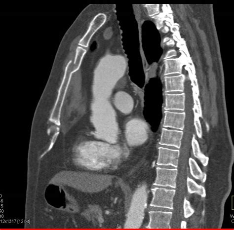 Sternal Fracture with Retrosernal Hematoma - Trauma Case Studies - CTisus CT Scanning