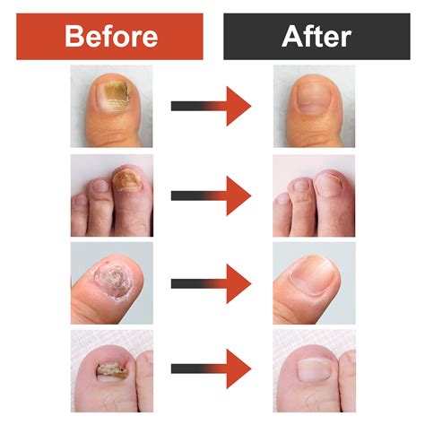 Severe Fungal Nail Treatment – Klipp Nail Care