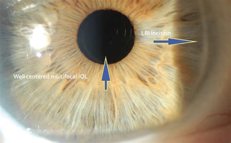 CRSToday | Fluctuating Vision With a Multifocal IOL