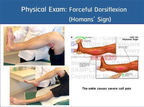 Deep vein thrombosis