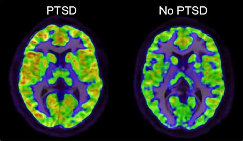 Potential New Path For PTSD Treatment - Neuroscience News