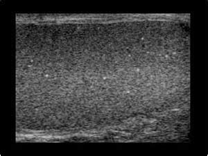 Urinary Tract and male reproductive system | 2.3 Scrotum : Case 2.3.13 Microlithiasis and ...