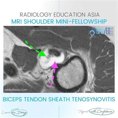 BICEPS TENDON SHEATH TENOSYNOVITIS EFFUSION MRI - Radedasia