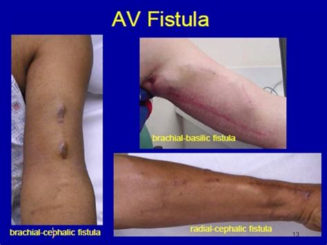 Arteriovenous Fistula - For Dialysis, Dural, Symptoms