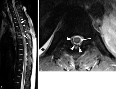 Thoracic spine MR imaging. A, Sagittal T2-weighted MR image of the... | Download Scientific Diagram