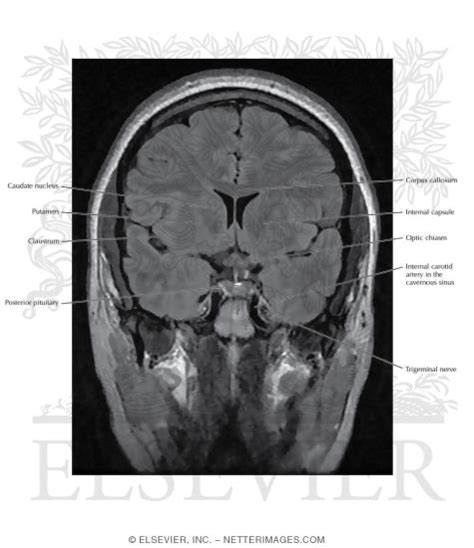 T2 FLAIR Coronal MRI Through the Optic Chiasm