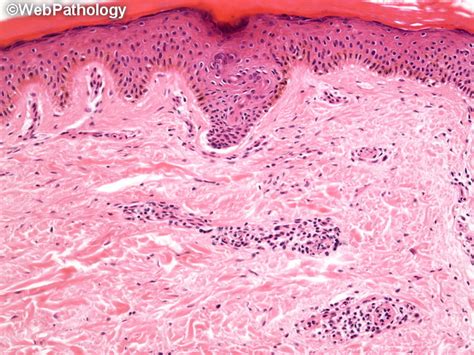 Webpathology.com: A Collection of Surgical Pathology Images