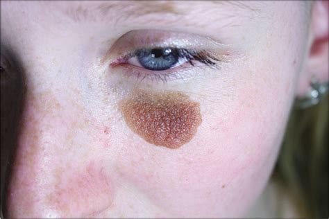 Congenital Melanocytic Nevus Face